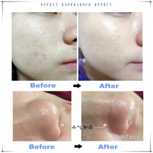 Ipartner Hidrógeno oxígeno Burbuja pequeña hidrofacial 6 en 1 limpiador de piel multifunción