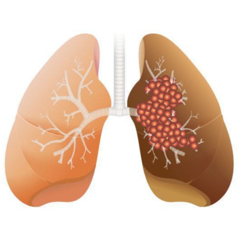 La dosis alta de NMN inhibe el crecimiento del adenocarcinoma de pulmón