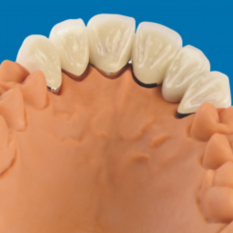 Metal-dientes de porcelana