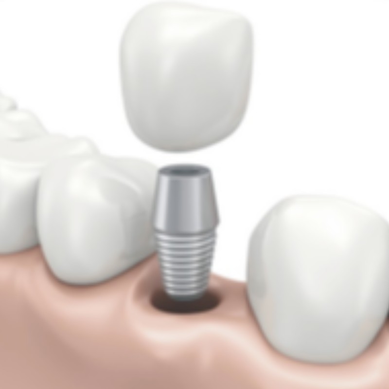 implante dental